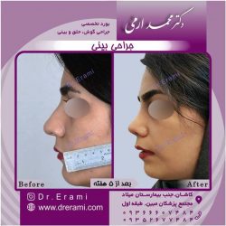 جراحی-بینی-53