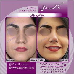 جراحی-بینی-54