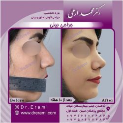 جراحی-بینی-55