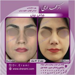 جراحی-بینی-56