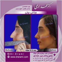 جراحی-بینی-8