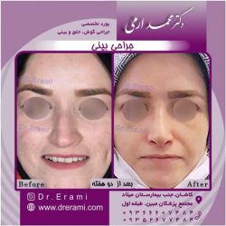 جراحی-بینی-84