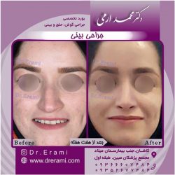 جراحی-بینی-85