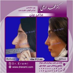 جراحی-بینی-9