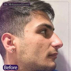 Rhinoplasty-349