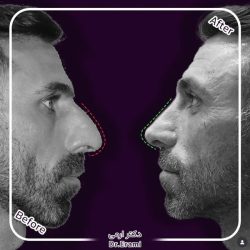 Rhinoplasty-359
