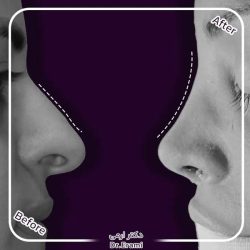 Rhinoplasty-360