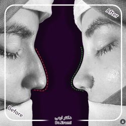 Rhinoplasty-361 Rhinoplasty-361