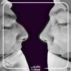 Rhinoplasty-362 Rhinoplasty-362