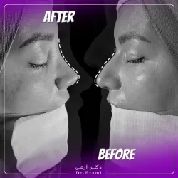 rhinoplasty-355