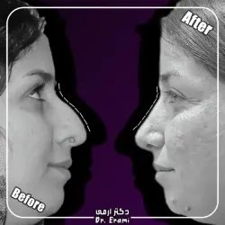 rhinoplasty-356