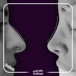 rhinoplasty-357