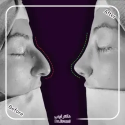 rhinoplasty-358