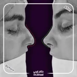 rhinoplasty-363