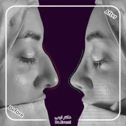 rhinoplasty-364