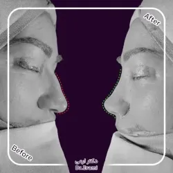 rhinoplasty-365