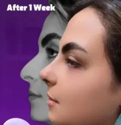 rhinoplasty-367