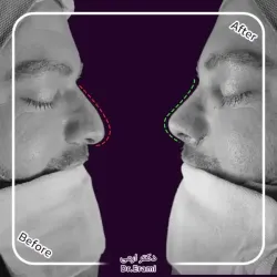 rhinoplasty-368
