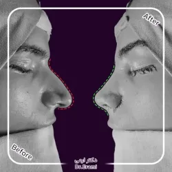 rhinoplasty-369