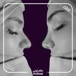 rhinoplasty-370