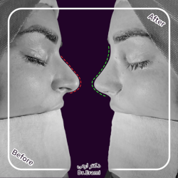 rhinoplasty-371
