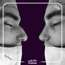 rhinoplasty-372