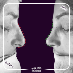 rhinoplasty-373