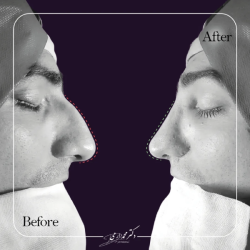 rhinoplasty-374