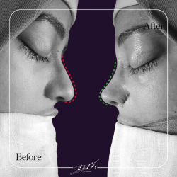 rhinoplasty-375