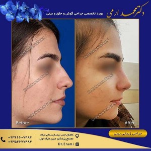جراحی بینی - دکتر محمد ارمی