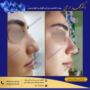 جراحی بینی طبیعی در کاشان - دکتر ارمی