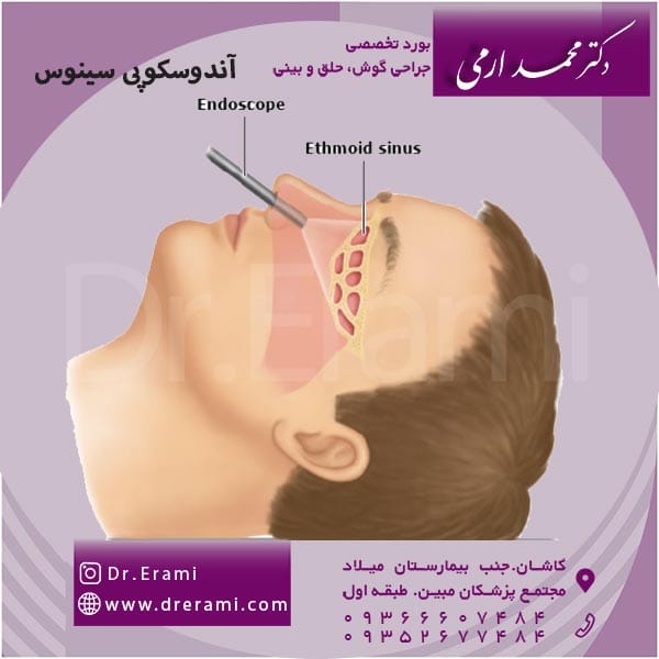 آندوسکوپی سینوس - دکتر ارمی
