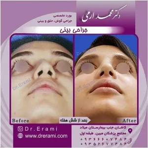 جراحی بینی نیمه فانتزی - دکتر ارمی
