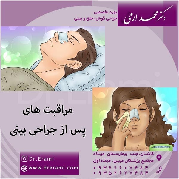 مراقبت های پس از جراحی بینی