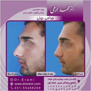 جراحی بینی در کاشان - دکتر ارمی