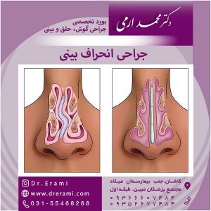 جراحی انحراف بینی در کاشان - دکتر ارمی