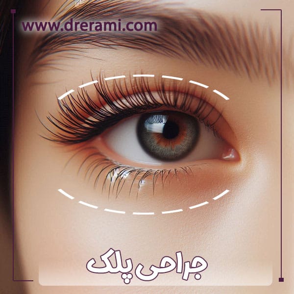 جراحی پلک در کاشان - دکتر محمد ارمی