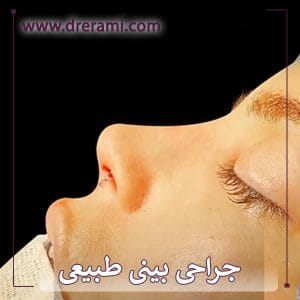 جراحی بینی طبیعی در کاشان توسط دکتر محمد ارمی