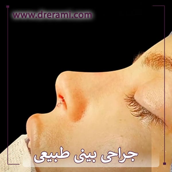 جراحی بینی طبیعی در کاشان توسط دکتر محمد ارمی