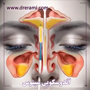 تخلیه سینوس با آندوسکوپی _ دکتر محمد ارمی