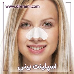 اسپلینت بینی - دکتر محمد ارمی