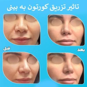 تزریق آمپول کورتون به بینی بعد از عمل _ دکتر محمد ارمی