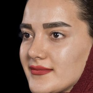نمونه کار جراحی بینی گوشتی _ دکتر محمد ارمی 