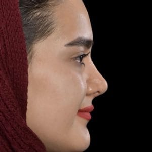قبل و بعد عمل بینی گوشتی _ دکتر محمد ارمی