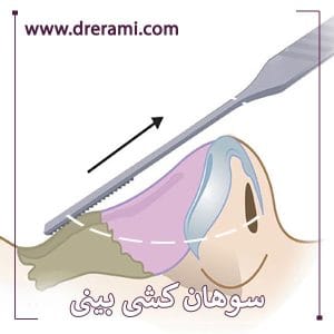 سوهان کشی بینی در اصفهان - دکتر محمد ارمی 
