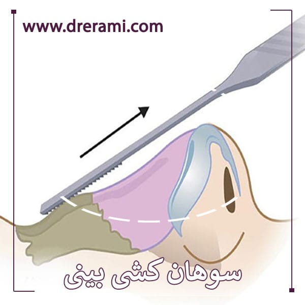 سوهان کشی بینی بعد از عمل - دکتر محمد ارمی