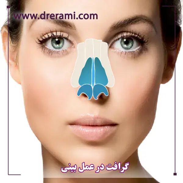 گرافت در عمل بینی _ دکتر محمد ارمی