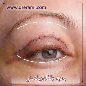 جای اسکار بخیه جراحی پلک _ دکتر محمد ارمی