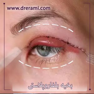 جای بخیه عمل پلک _ دکتر محمد ارمی 