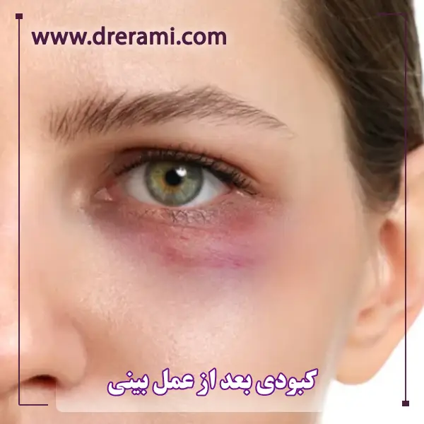 کبودی بعد از جراحی بینی _ دکتر محمد ارمی